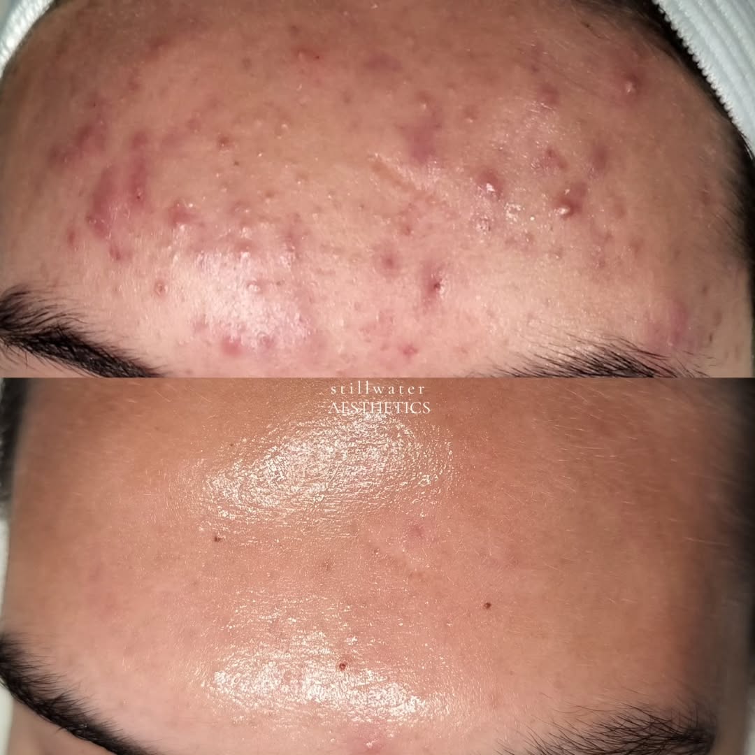 Before and after acne treatment results