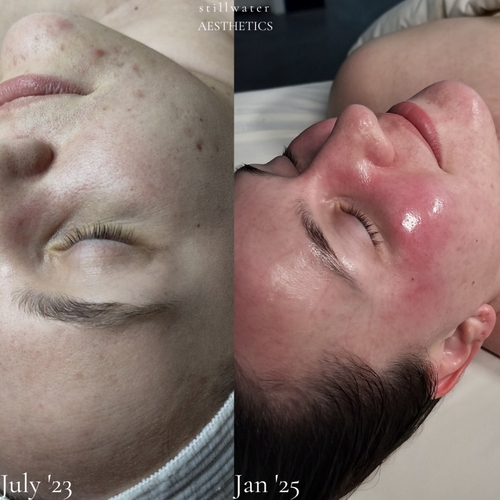 Before and after pigmentation and tone results over time