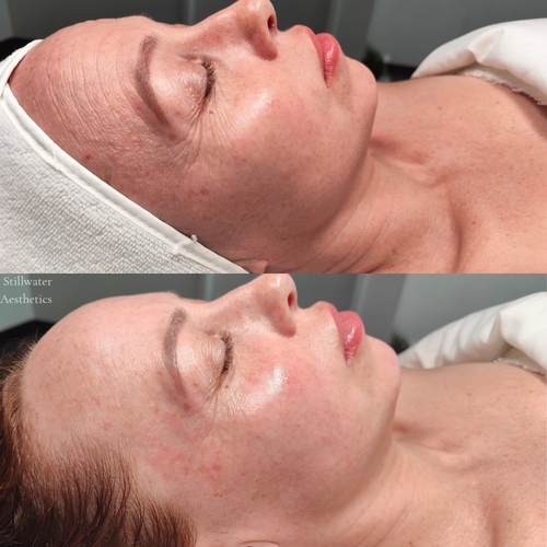 Before and after facial rejuvenation results