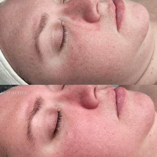Before and after skin clarity and glow results